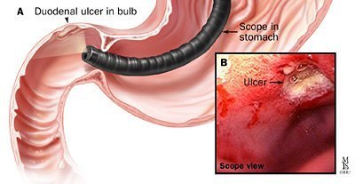 Ulcera duodenale cagliari sardegna con gastroduodeno