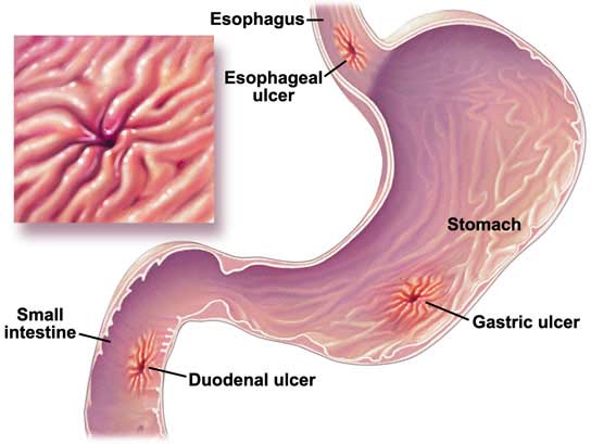 Ulcera gastrica sardegna-cagliari